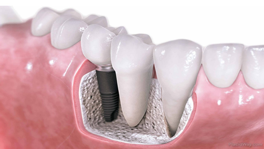Dental Implants Ballito
